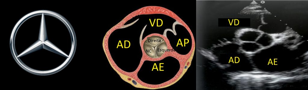 O Que Vemos No Ecocardiograma Abaixo Temas Em Cardiologia