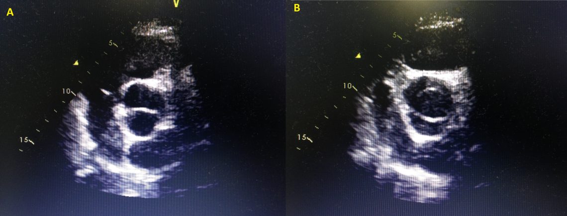 O Que Vemos No Ecocardiograma Abaixo Temas Em Cardiologia